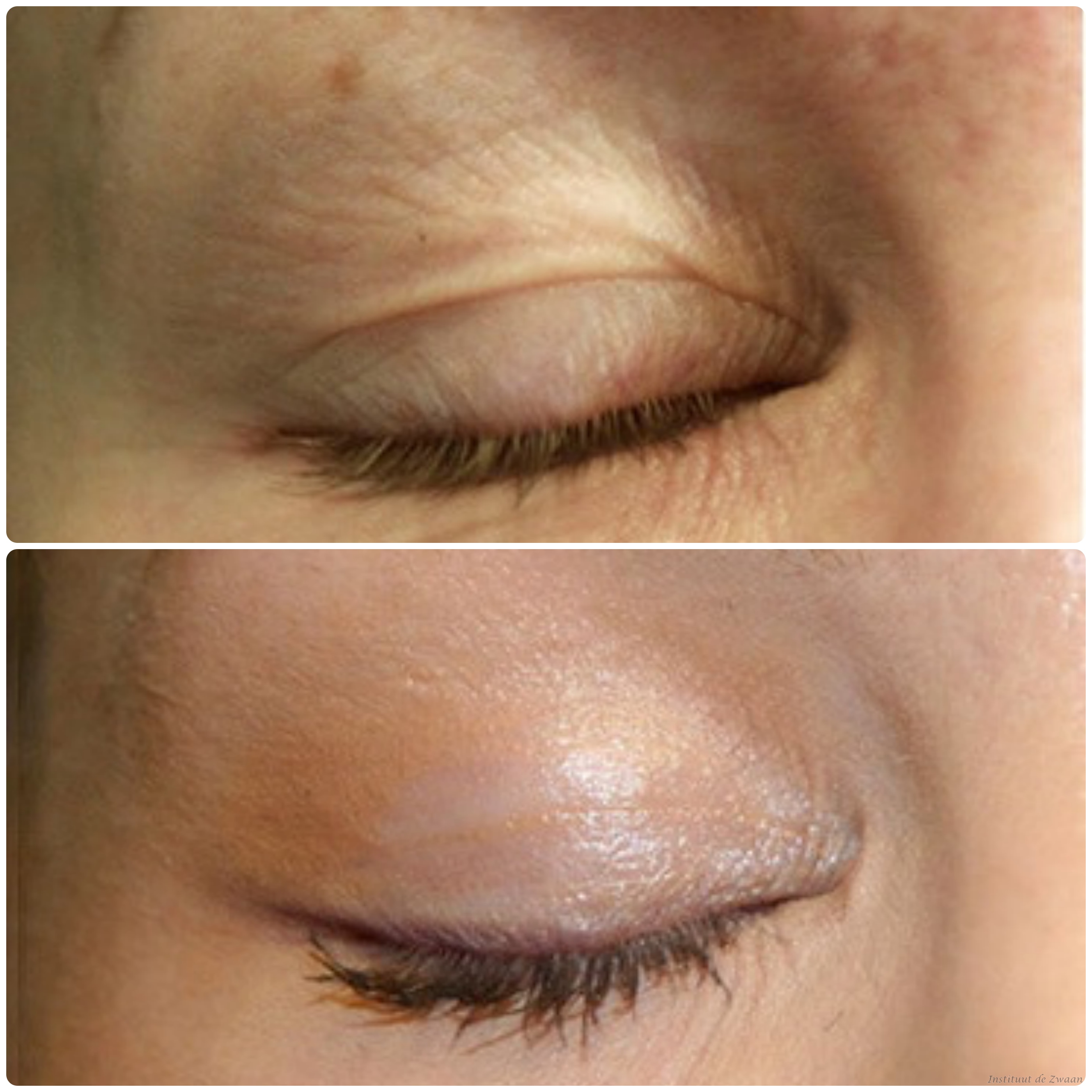 Bleferoplasti 2.jpg Bleferoplasti 2.jpg