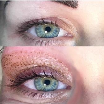 ooglift-beeld-correctie2 ooglift-beeld-correctie2